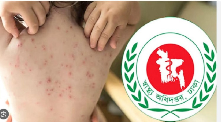 দেশে হামের উপসর্গে আরও ৬ জনের মৃত্যু, মোট প্রাণহানি ১ হাজার ২৩৩