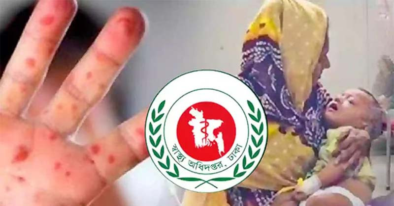 দেশে হামের উপসর্গে আরও ৬ জনের মৃত্যু, মোট প্রাণহানি ১১৭০